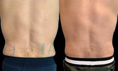 Coolsculpting Before & After Gallery - Patient 327039 - Image 1