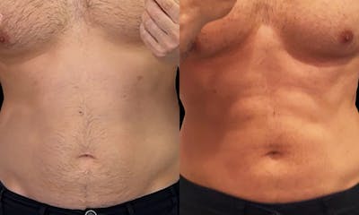 Coolsculpting Before & After Gallery - Patient 210745 - Image 1