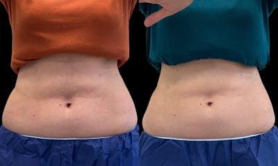 Coolsculpting Before & After Gallery - Patient 257963 - Image 1