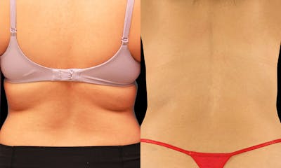 Coolsculpting Before & After Gallery - Patient 219036 - Image 1