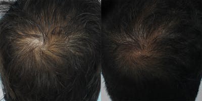 Exosomes Before & After Gallery - Patient 298026 - Image 1