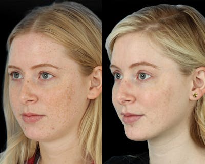 Hyperpigmentation Before & After Gallery - Patient 355824 - Image 1