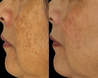 Hyperpigmentation Before & After Gallery - Patient 283461 - Image 1
