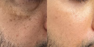 Hyperpigmentation Before & After Gallery - Patient 118671 - Image 1