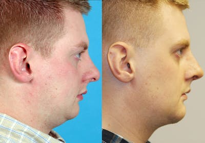 Facial Implants Before & After Gallery - Patient 370735 - Image 1