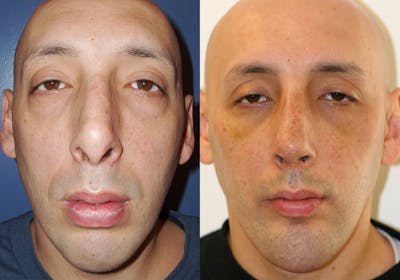 Facial Implants Before & After Gallery - Patient 384922 - Image 1