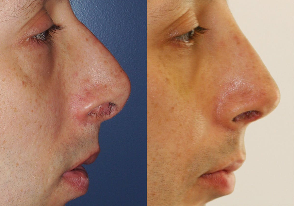 Facial Implants Before & After Gallery - Patient 384922 - Image 3