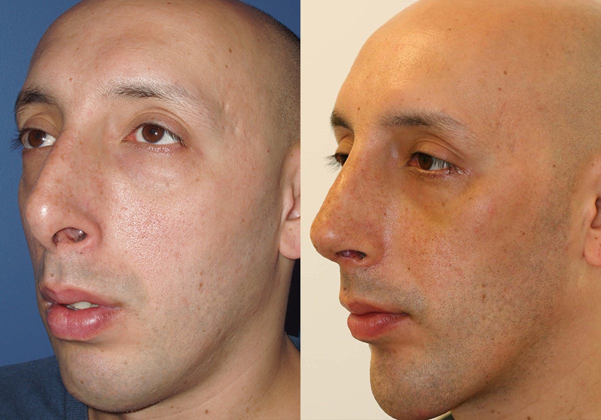 Facial Implants Before & After Gallery - Patient 384922 - Image 2