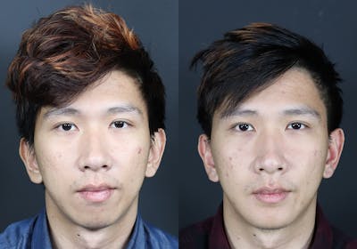Facial Implants Before & After Gallery - Patient 160162 - Image 1