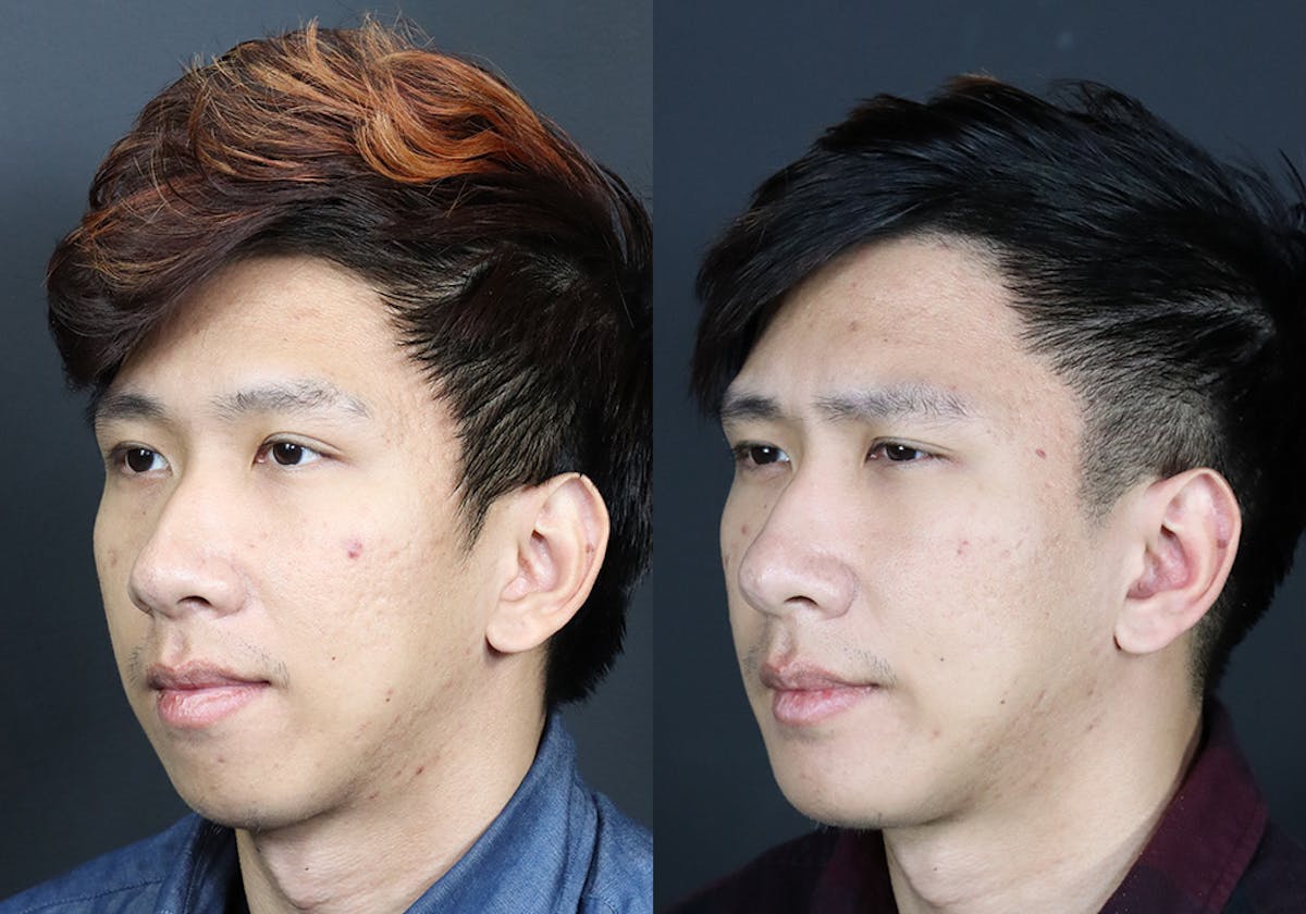 Facial Implants Before & After Gallery - Patient 160162 - Image 2