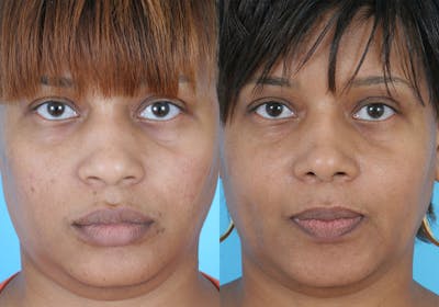 Facial Implants Before & After Gallery - Patient 237564 - Image 1
