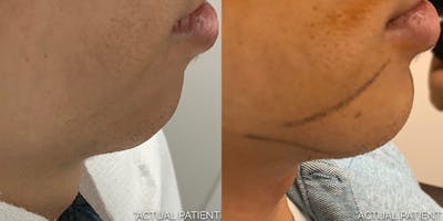 Facial Implants Before & After Gallery - Patient 254677 - Image 1