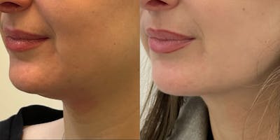 BOTOX Fillers Before & After Gallery - Patient 980646 - Image 1