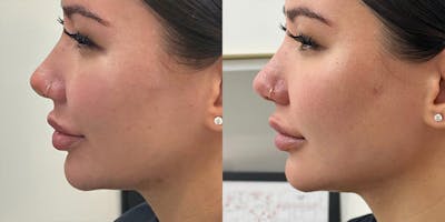 BOTOX Fillers Before & After Gallery - Patient 380529 - Image 1