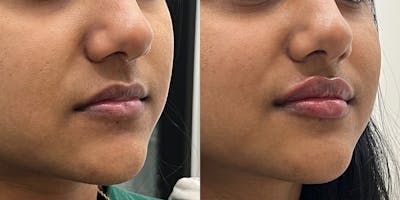 BOTOX Fillers Before & After Gallery - Patient 409638 - Image 1
