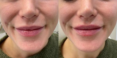 BOTOX Fillers Before & After Gallery - Patient 184883 - Image 1