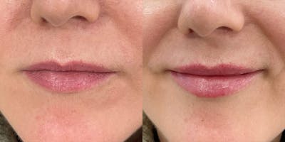 BOTOX Fillers Before & After Gallery - Patient 579919 - Image 1