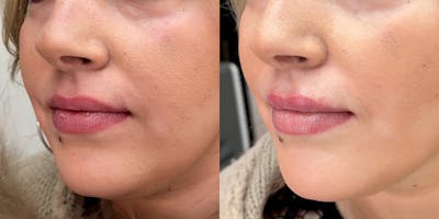 BOTOX Fillers Before & After Gallery - Patient 963285 - Image 1