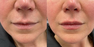 BOTOX Fillers Before & After Gallery - Patient 342016 - Image 1