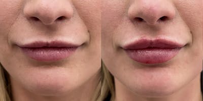 BOTOX Fillers Before & After Gallery - Patient 264578 - Image 1