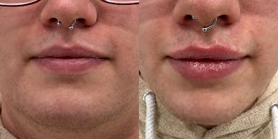 BOTOX Fillers Before & After Gallery - Patient 256515 - Image 1
