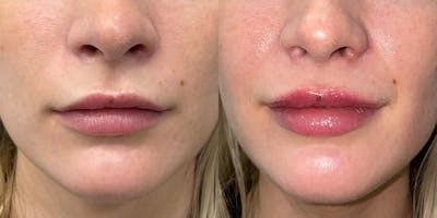 BOTOX Fillers Before & After Gallery - Patient 203750 - Image 1