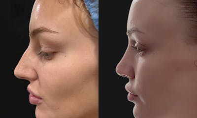 Rhinoplasty Before & After Gallery - Patient 334167 - Image 1