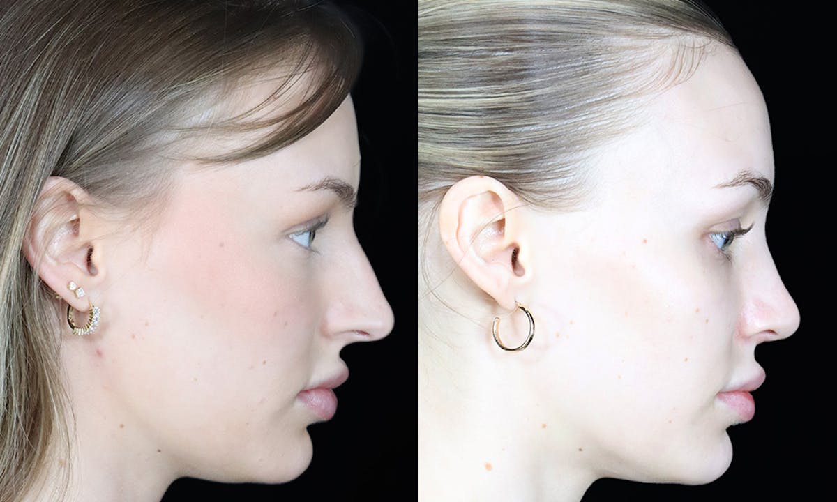 Rhinoplasty Before & After Gallery - Patient 334167 - Image 3