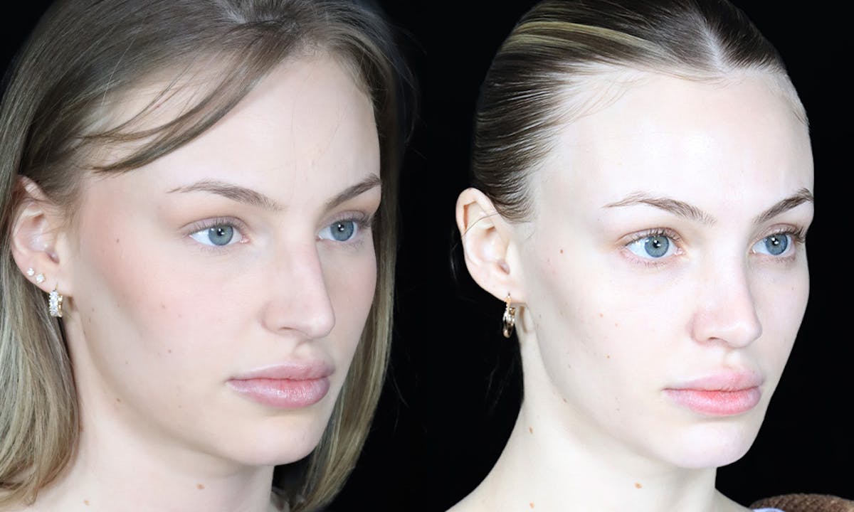 Rhinoplasty Before & After Gallery - Patient 334167 - Image 2
