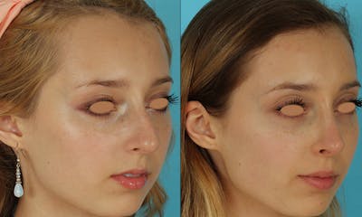 Rhinoplasty Before & After Gallery - Patient 105357 - Image 1