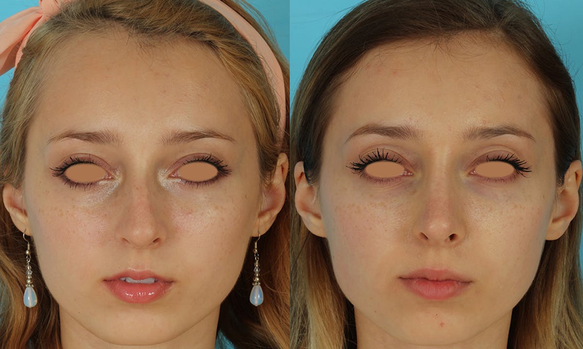 Rhinoplasty Before & After Gallery - Patient 105357 - Image 3