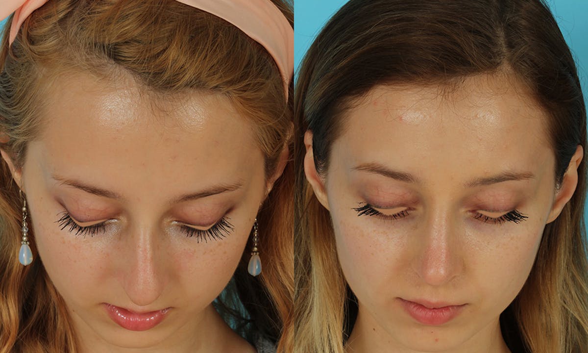Rhinoplasty Before & After Gallery - Patient 105357 - Image 2