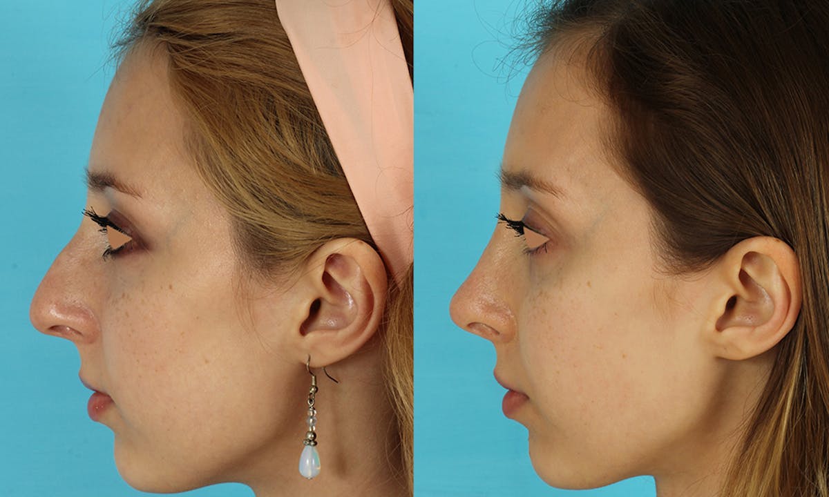 Rhinoplasty Before & After Gallery - Patient 105357 - Image 4