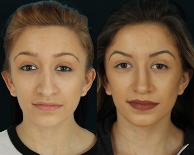 Rhinoplasty Before & After Gallery - Patient 295330 - Image 1