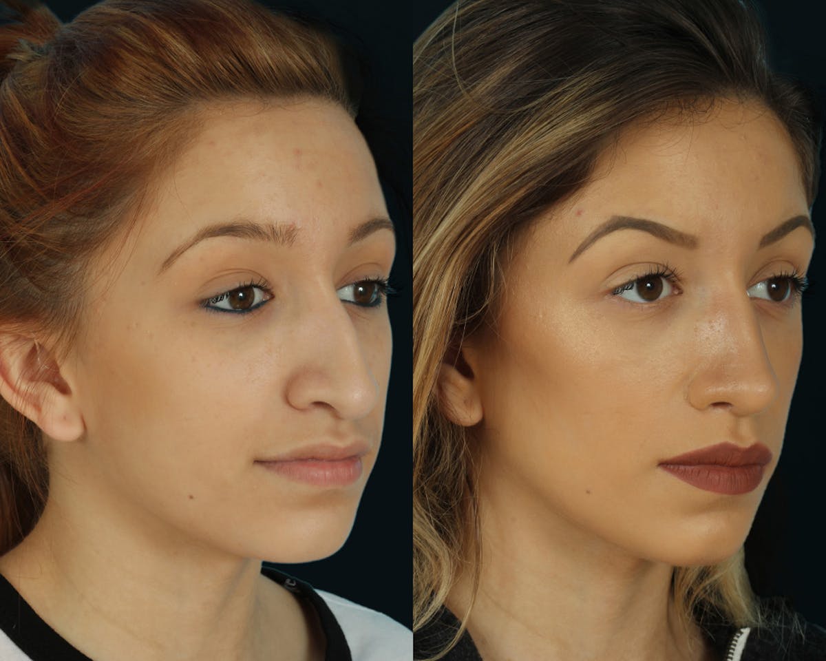 Rhinoplasty Before & After Gallery - Patient 295330 - Image 3