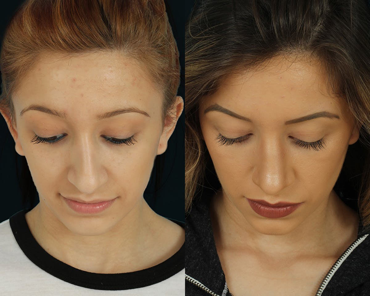 Rhinoplasty Before & After Gallery - Patient 295330 - Image 2