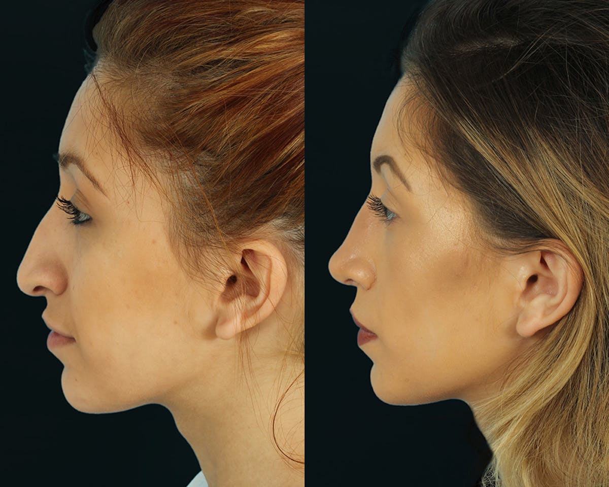 Rhinoplasty Before & After Gallery - Patient 295330 - Image 4