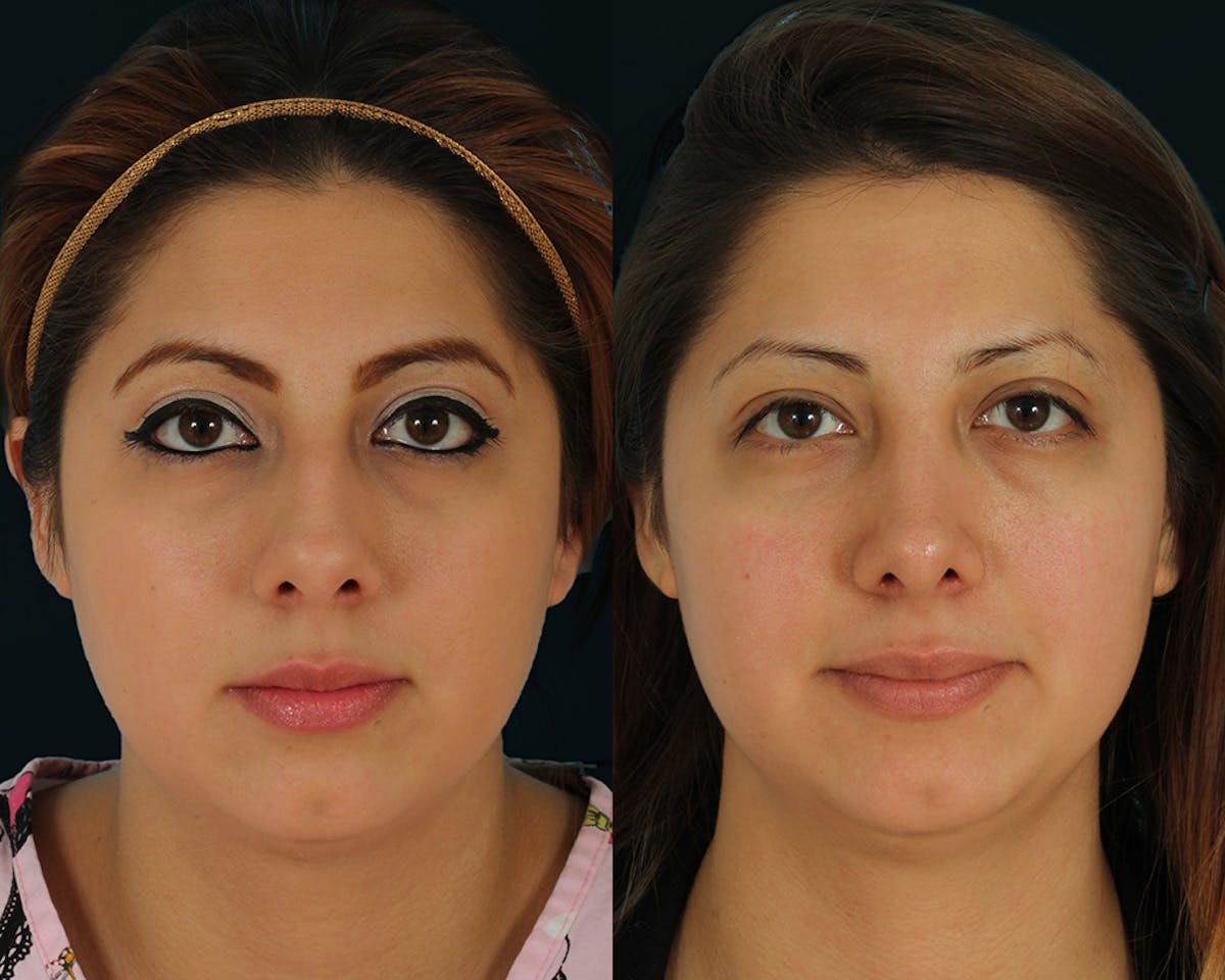 Rhinoplasty Before & After Gallery - Patient 635268 - Image 4