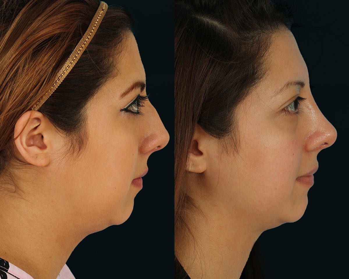 Rhinoplasty Before & After Gallery - Patient 635268 - Image 2