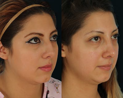 Rhinoplasty Before & After Gallery - Patient 635268 - Image 1