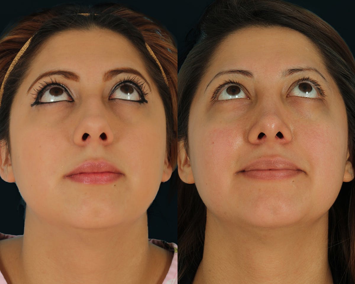 Rhinoplasty Before & After Gallery - Patient 635268 - Image 3