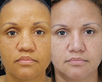 Rhinoplasty Before & After Gallery - Patient 519868 - Image 1