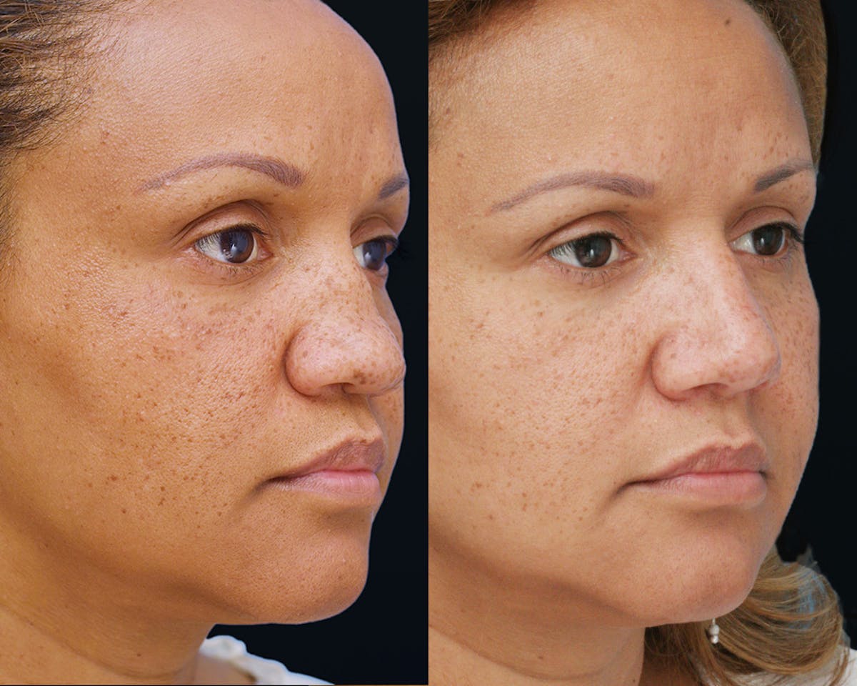 Rhinoplasty Before & After Gallery - Patient 519868 - Image 3