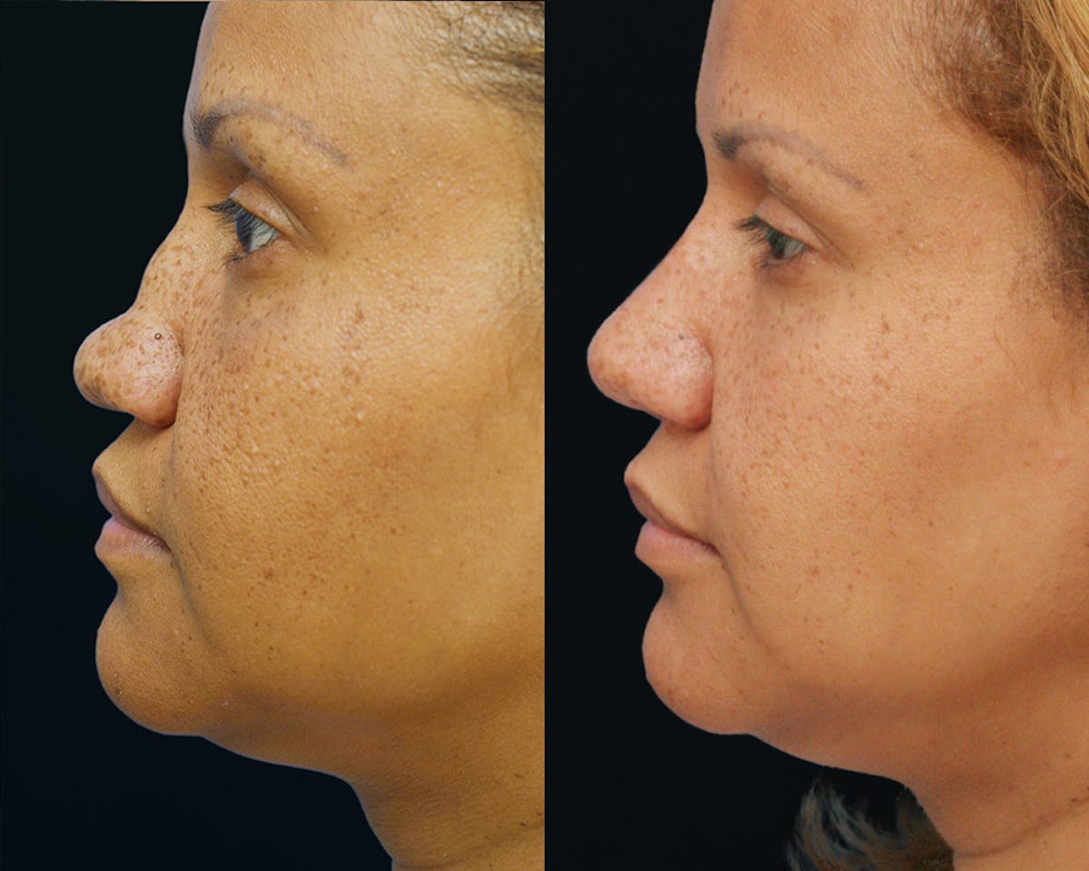 Rhinoplasty Before & After Gallery - Patient 519868 - Image 2