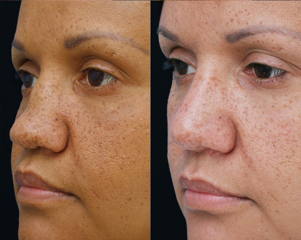 Rhinoplasty Before & After Gallery - Patient 519868 - Image 5