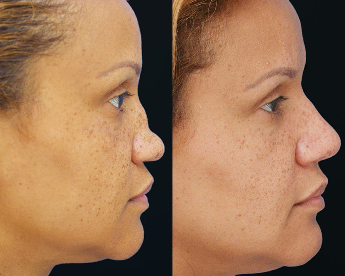 Rhinoplasty Before & After Gallery - Patient 519868 - Image 4
