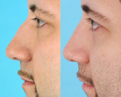 Rhinoplasty Before & After Gallery - Patient 183007 - Image 1