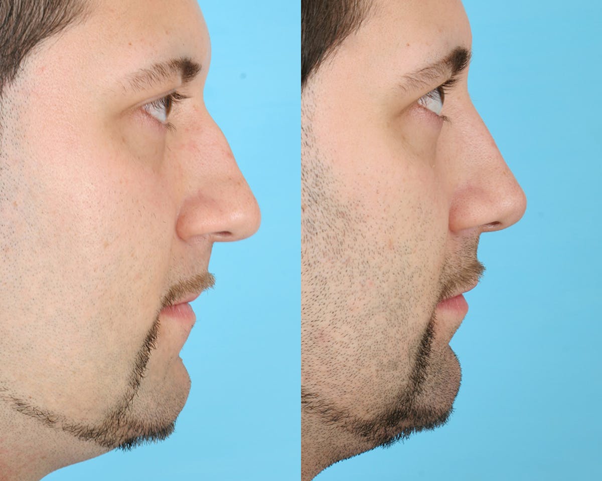 Rhinoplasty Before & After Gallery - Patient 183007 - Image 3