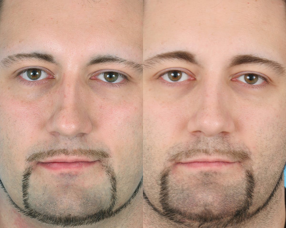 Rhinoplasty Before & After Gallery - Patient 183007 - Image 2