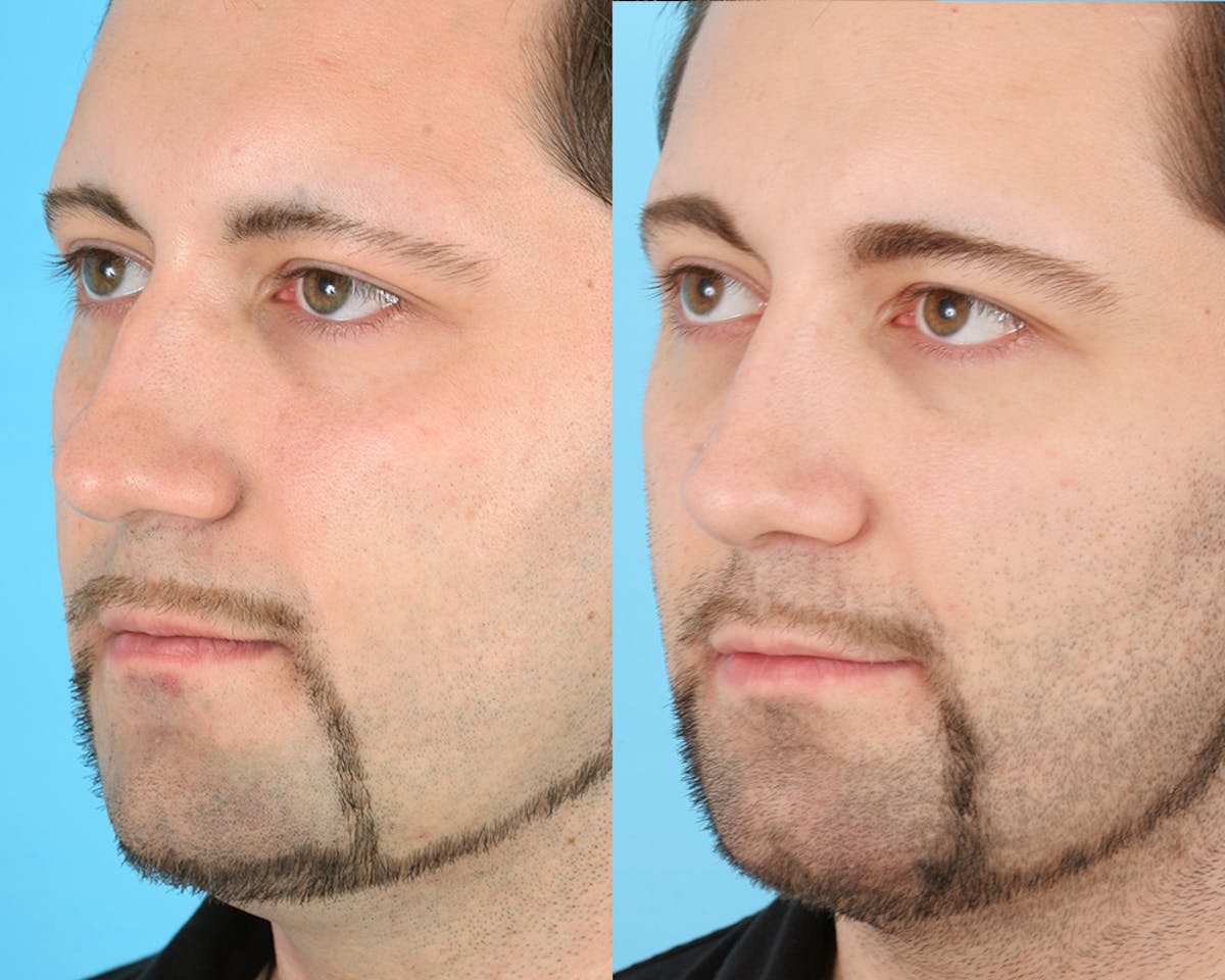 Rhinoplasty Before & After Gallery - Patient 183007 - Image 4